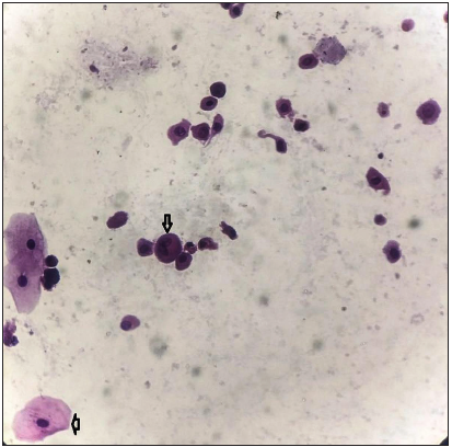 Is liquid-based cytology an alternative to conventional cytology for detection of malignant cells in urine of bladder cancer? Eastern Indian prospective observational study
