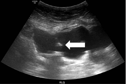 Management of Indiana pouch stones through a percutaneous approach: A single center experience
